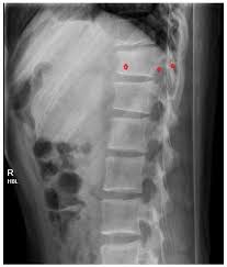Image result for Chance Fracture