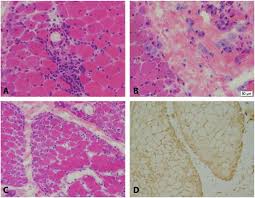 Recessed lighting installation necrotizing myopathy symptoms muscle. Dermatomyositis Polymyositis And Immune Mediated Necrotising Myopathies Sciencedirect