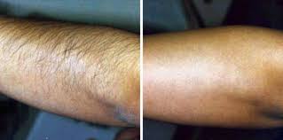 Webmd explains laser hair removal, including costs, benefits, and side effects. Pin On Hair Tattoo Removal