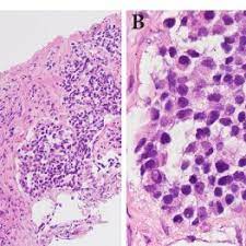 Msk lung cancer physicians include thoracic surgeons, medical oncologists, radiation oncologists, radiologists, and pathologists. Pdf Lung Cancer Or Sarcoidosis A Diagnostic Dilemma