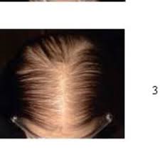 Some types of hair loss are permanent, like male and female pattern. Pdf Quality Of Life In Australian Women With Female Pattern Hair Loss 2010 04 19 2010 07 06 2010 08 06