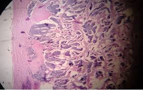 Carcinoid tumors are of neuroendocrine origin and derived from primitive stem cells in the gut wall carcinoid tumors can be nonfunctioning presenting as a tumor mass or functioning i.e. Tumor Carcinoide En Intestino Delgado Presentacion De Un Caso