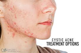 If severe a few days of a steroid will help, then you may need an occlusion splint made by a dentist. Everything You Need To Know About Cystic Acne Treatment