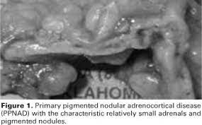 This page is about the various possible meanings of the acronym, abbreviation, shorthand or slang term: Scielo Brasil Primary Pigmented Nodular Adrenocortical Disease And Cushing S Syndrome Primary Pigmented Nodular Adrenocortical Disease And Cushing S Syndrome
