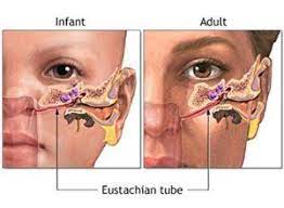 Blocked Ears Ent Clinic Sydney Ear Infection Remedy Ear Tubes Eustachian Tube Dysfunction