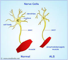 Amyotrophic Lateral Sclerosis Als Lou Gehrig S Disease Symptoms Diagnosis Treatment Amyotrophic Lateral Sclerosis Lou Gehrigs Disease Als Lou Gehrig