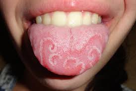 green tongue causes infections and treatments