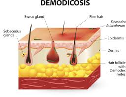 Alopecia areata is a form of hair loss produced by the autoimmune destruction of hair follicles in localized areas of skin. Face Mites Demodex Folliculorum Overview And More