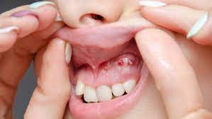 Maybe you would like to learn more about one of these? Mengenal Gum Boil Penyebab Gusi Bengkak Dan Bernanah