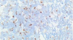 We did not find results for: Das Merkelzellkarzinom Selten Und Schwer Zu Diagnostizieren Springermedizin De