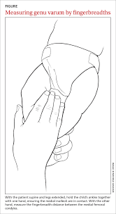 Image result for Genu Varum