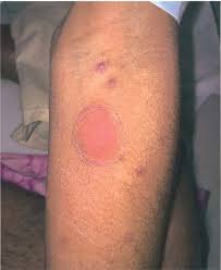 We did not find results for: Strongly Positive Mantoux Test 30mm Of Induration Download Scientific Diagram