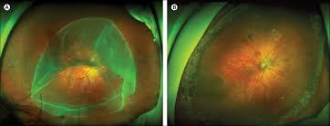 This is likely due to the vessels blocking the exiting light. Retinal Detachment In Severe Myopia The Lancet