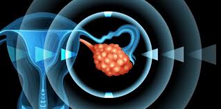 A biotechnology company shaping the future of cancer #immunotherapies by translating compelling science into patient benefit. Sotio S Cell Therapy Increases Survival In Ovarian Cancer By 62