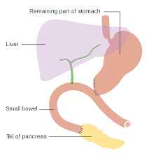 Most often, pancreatic cancer starts in the ducts that carry pancreatic juices. Pancreaticoduodenectomy Wikipedia