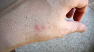 Image result for bedbugs bites