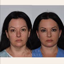 Andrew S. Frankel, MD, FACS (@drandrewfrankel) • Instagram photos and videos