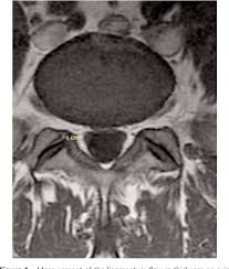 We did not find results for: Pdf Ligamentum Flavum Hypertrophy In Elderly Patients With Low Back Pain A Mri Study Semantic Scholar