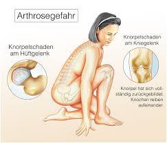 Arthrose Symptome Behandlung Und Vorbeugung