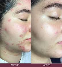 Последние твиты от tixel (@tixelofficial). Tixel Mezotix Skin Rejuvenation Skin Excellence Clinics
