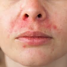 Image result for ekzema face