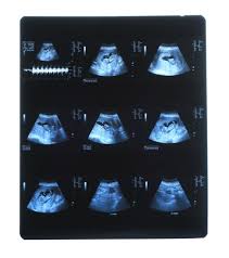Primer Trimestre Ultrasonido Bebe Xray De Piernas De Fraternal Gemelos Fotos Retratos Imagenes Y Fotografia De Archivo Libres De Derecho Image 8496254