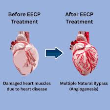 How EECP Helps? | EECP Treatment | EECP Therapy | OPLUS