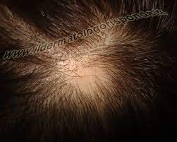 La ricrescita dei capelli nei casi di alopecia areata: Alopecia Areata In Dermatologia Come Riconoscerla Foto