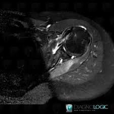 Radiology Case Parsonage Turner Syndrome Mri Diagnologic