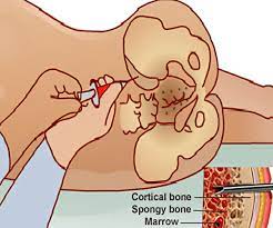 Check spelling or type a new query. Bone Marrow Aspiration And Biopsy Indications Common Sites Performed Risks Faqs