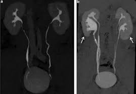 Image result for Helical CT Urogram