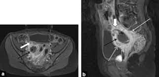 This ovarian cancer awareness month, ovarian cancer action is calling on the uk to #ovaryact; Digestive Diseases Mimicking Primary Gynecological Diseases Or With Secondary Gynecological Manifestations Sciencedirect