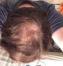 You can use a spray or colorants that match your hair and scalp color to fill in thinning areas of your scalp and reduce the appearance of thinning. Male 22 Thinning Hair At Crown Sudden Seeking Advice Hairlosstalk Forums
