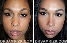 Facial Plastic Surgeon NYC