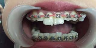 We did not find results for: Beli Kawat Gigi Di Online Shop Gigi Gadis Ini Jadi Hancur Feed Merdeka Com