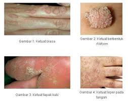 Ketuat atau viral warts sangat mudah berjangkit dan merebak melalui sentuhan atau contact. Klinik Syifa Ketuat Ketuat Disebabkan Oleh Jangkitan Virus Human Papillomavirus Hpv Ia Boleh Melibatkan Bahagian Kulit Dan Mukosa Seperti Di Bahagian Alat Kelamin Lelaki Dan Perempuan Penyebab Terdapat Lebih Dari 100