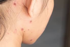 Cacar air merupakan infeksi yang disebabkan virus varicella zoster dengan gejala ruam berwarna kemerahan dan berisi air. Cacar Air Definisi Gejala Penyebab Pengobatan