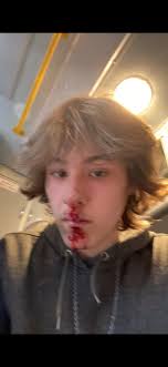 I had a 20 minute tonic clonic seizure and head drops.