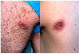 Image result for syphilis ulcer