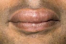 Angioedema Symptoms Nhs