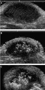 It is visualized as a circular formation with a liquid inside. B Mode Ultrasound Images Of Mda Mb231 Human Breast Cancer Tumor In A Download Scientific Diagram