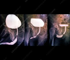 Image result for Voiding Cystourethrogram