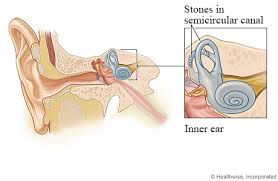 For how long does it take for benign positional vertigo to go away? Benign Paroxysmal Positional Vertigo Bppv Cigna