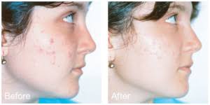 Blue Light Acne Treatment San Francisco Epi Center Med Spa