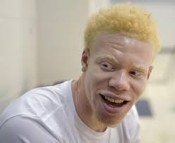 Maybe you would like to learn more about one of these? Tcu Athlete With Albinism Embraces His Life Appearance Across America Phillytrib Com