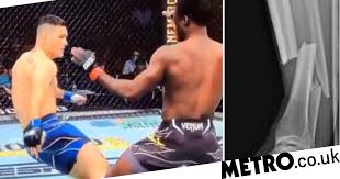 In april, weidman suffered a broken tibia and fibula after he. Chris Weidman Posts Gruesome X Ray Of Shattered Leg After Ufc 261 Global Circulate