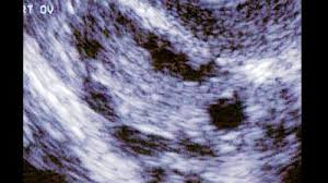 Alle fertilovit® produkte werden nach orthomolekularen grundsätzen hergestellt. Pco Syndrom Polyzystisches Ovarialsyndrom Babywelten Ch