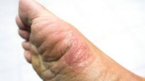 6 Razones Por Las Que Puedes Tener Picor En Los Pies Podovita Clinica Del Pie Lola Munoz