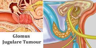 Image result for Glomus tumor