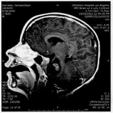 Sometimes, children with a brain stem glioma do not have any of these changes. Childhood Cancer Brain Cancer And Dipg Dipg Advocacy Group